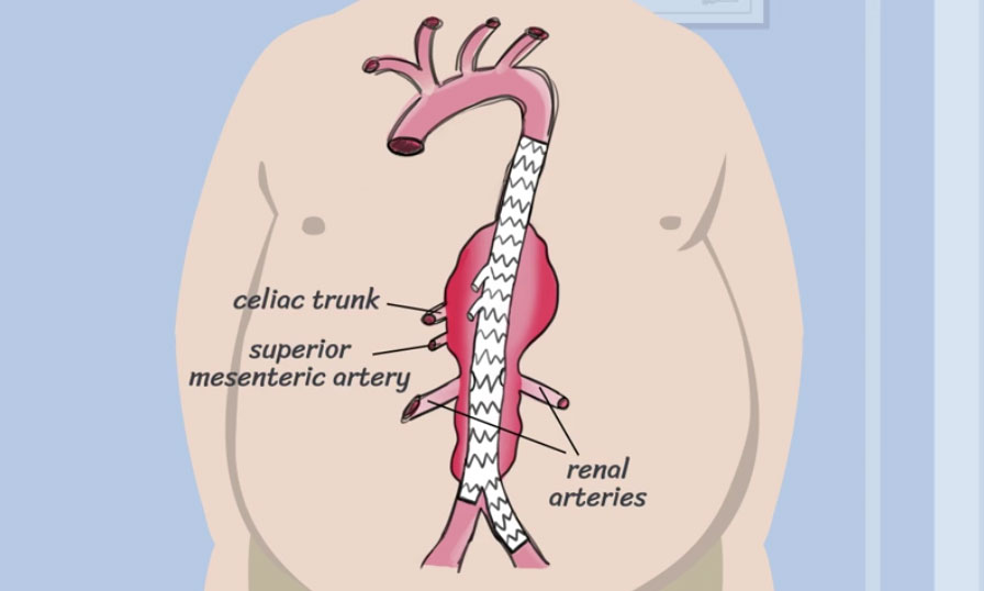 E-Learning Philips – Aortic aneurysms